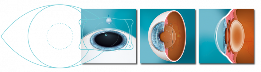 Bioptics-Eyecenter-Latem-Eeklo